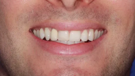 مراحل ایمپلنت دندان جلو